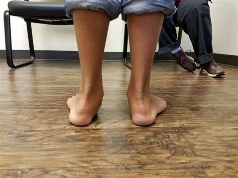 flexible pes planovalgus flexible flatfoot pediatrics orthobullets
