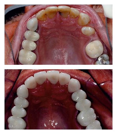 Dental Implants Before And After Bartholomew Dentist