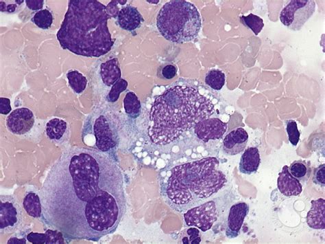 anaplastic large cell lymphoma bone marrow aspirate