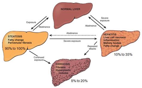 Morphology Of Alcoholic Liver Disease Medchrome