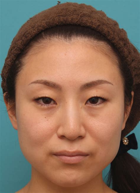 ボツリヌストキシン注射（エラ、プチ小顔術）でほっそりした小顔になった女性の症例写真の術前術後画像 ： 美容整形の高須クリニック（銀座高須
