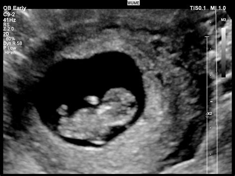 first ultrasound when pregnant oral sex
