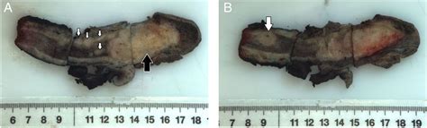 a rare case of metachronous penile and urethral metastases from a