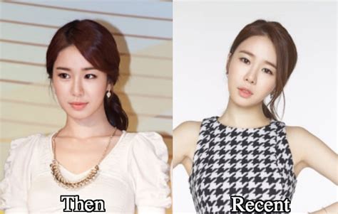 Yoo In Na Plastic Surgery Before And After Photos Latest