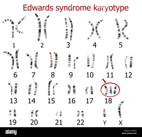Edwards Syndrom Karyotyp Stockfotografie Alamy
