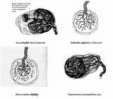 Placenta Anatomical Tripartite Varations Distinct Lobes sketch template