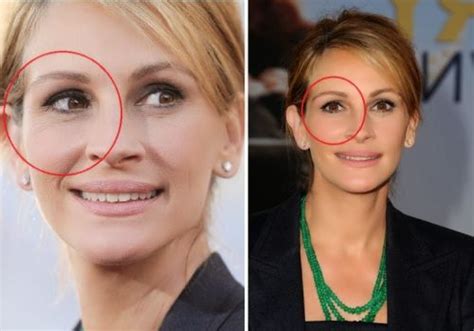 Julia Roberts Plastic Surgery Is The Pretty Woman All