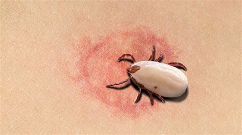 Lyme Disease Symptoms Causes Treatments And Prevention