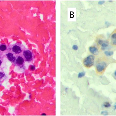 A And B Pathological Findings Of 7 Lymph Node Specimen Reveals