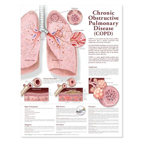 Chronic Obstructive Pulmonary Disease Copd Chart Poster Laminated
