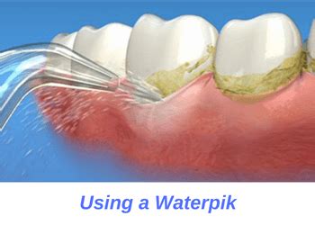 waterpik oceansight dental implants