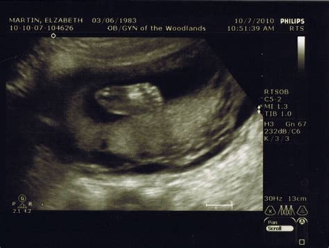 10 Little Toes 20 Week Ultrasound