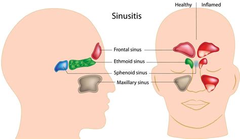 Best Antibiotic For Sinus Infection Best 2020