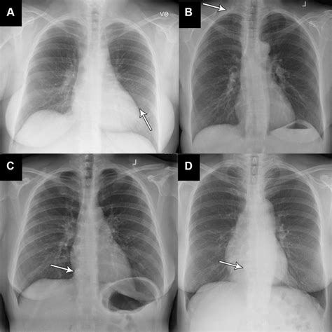 ai accurately identifies normal  abnormal chest  rays