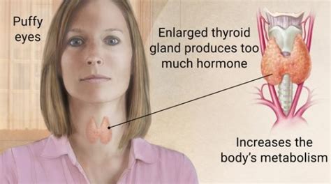 hyperthyroidism over active thyroid