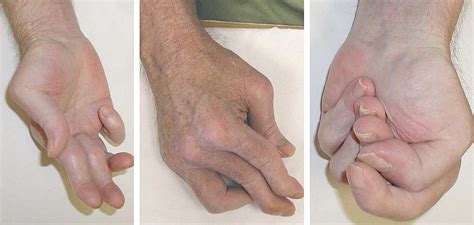 striatal deformities of the hand and foot in parkinson s disease the