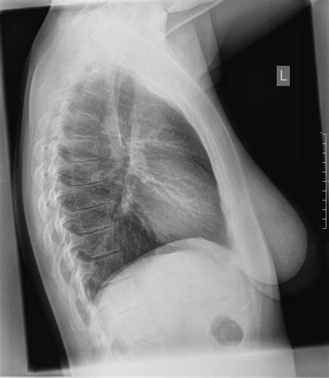 kann man eine lungenembolie beim thorax roentgen erkennen thoraxschmerzen
