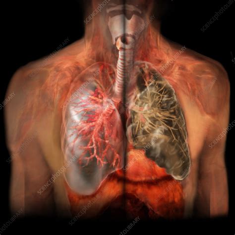 healthy lung  smokers lung stock image  science