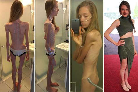 ‘anorexia nearly killed me girl 22 was days away from death after dropping to five stone