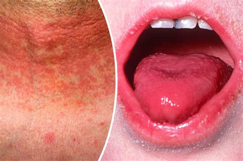 Scarlet Fever Symptoms Outbreaks Reach 50 Year High – Here Are The