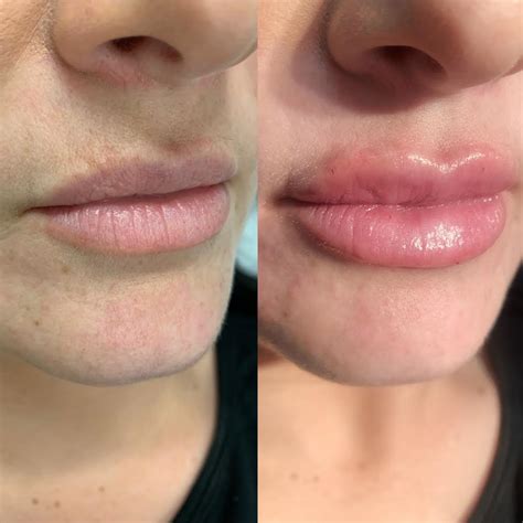 lip filler aftercare things to avoid after lip injections gcps