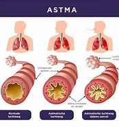 Bilderesultat for Astma Nhi. Størrelse: 174 x 185. Kilde: www.wehale.life