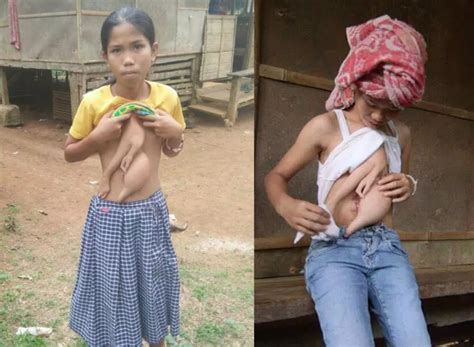 parasitic twin sister girl living with two extra arms and half formed fingers on her stomach to