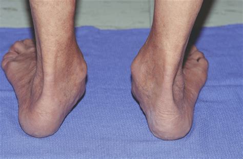 Adult Acquired Flat Foot Posterior Tibialis Tendon