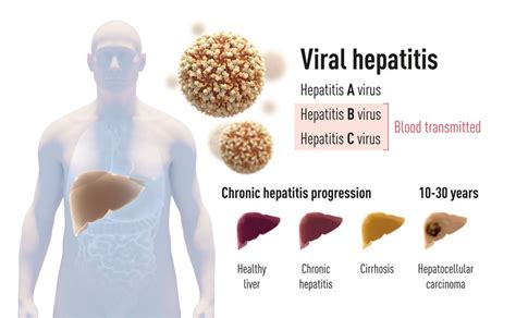 Premio Nobel De Medicina Al Descubrimiento Del Virus De La Hepatitis C