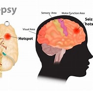 Bildergebnis für Epilepsie durch Hippokampussklerose. Größe: 189 x 185. Quelle: www.standardmedia.co.ke
