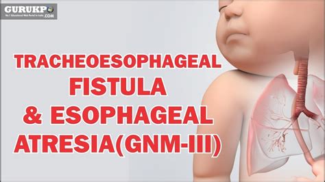 Tracheoesophageal Fistula And Esophageal Atresia Gnm Iii Youtube