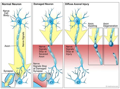 damaged neurons  diffuse axonal injury medmoviecom