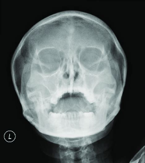X Ray Paranasal Sinuses Open Mouth View Showing Haziness Of Bilateral