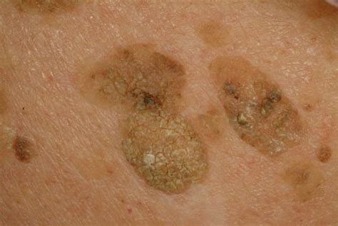 liver spots pictures face skin hands  treatment