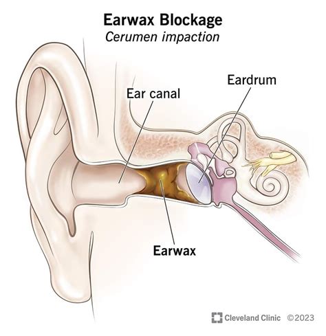 immersion descriptive    earwax clean disorder  fun duchess