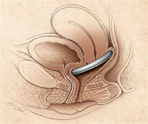 Prolapsed Uterus Causes Signs Symptoms Treatment And