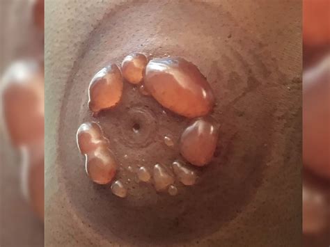 A Woman Fell Asleep During Cupping Therapy She Woke Up