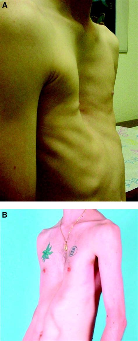 Current Management Of Pectus Excavatum A Review And Update Of Therapy