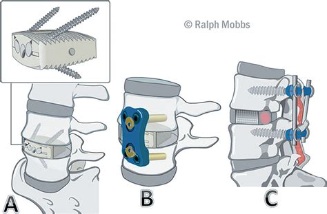 Figure 3 From Indications For Anterior Lumbar Interbody