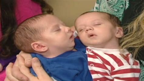 Conjoined Twins Separated In 14 Hour Op