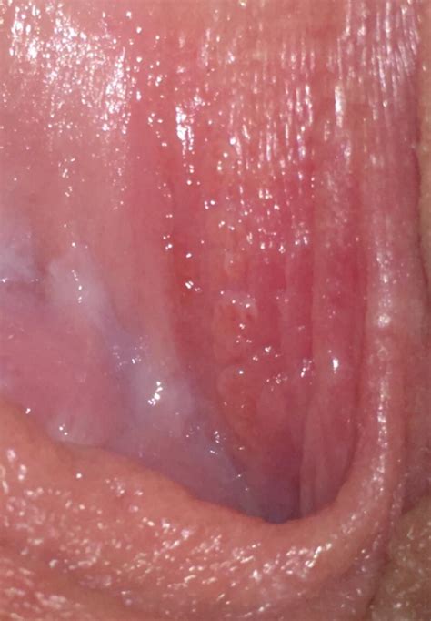 Hpv Help Please Sexual Health Forums Patient