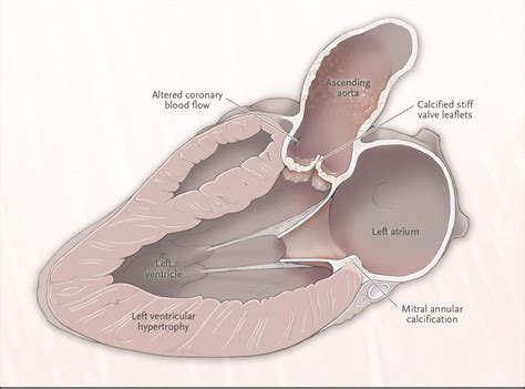 Aortic Valve Stenosis — From Patients At Risk To Severe Valve