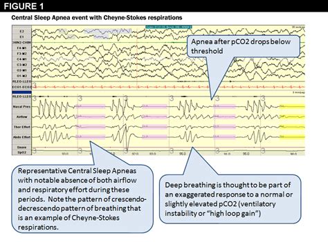 Obstructive And Central Sleep Apnea Online Pdf Read Online Kariage Kun