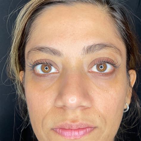 prf  undereyes  northern virginia mountcastle medical spa