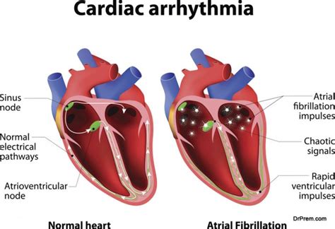 Cardiac Arrhythmia Symptoms Diagnosis And Treatment