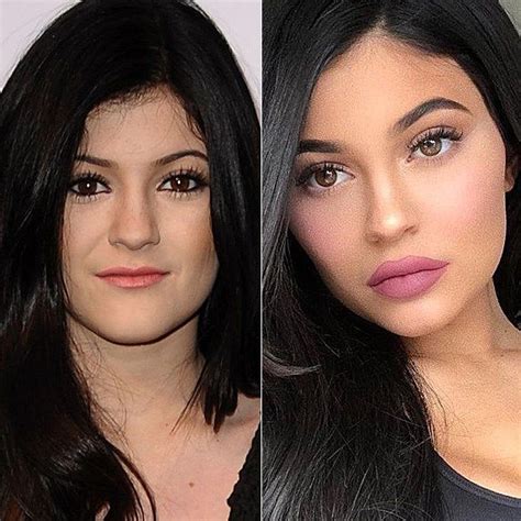 before and after did these celebs get lip injections in 2022 kylie