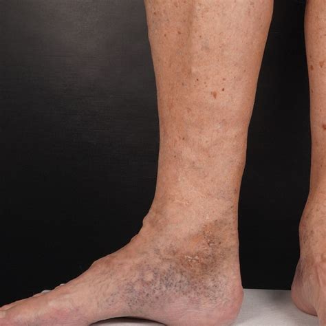 skin  affected  bad leg veins  veincare centre