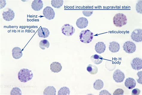 heinz bodies and reticulocytes in alpha thalassemia major in post