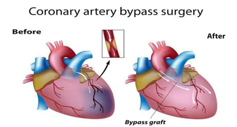 bypass surgery      mind read health related blogs articles news