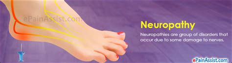 Neuropathy Classification Types Causes Risk Factors